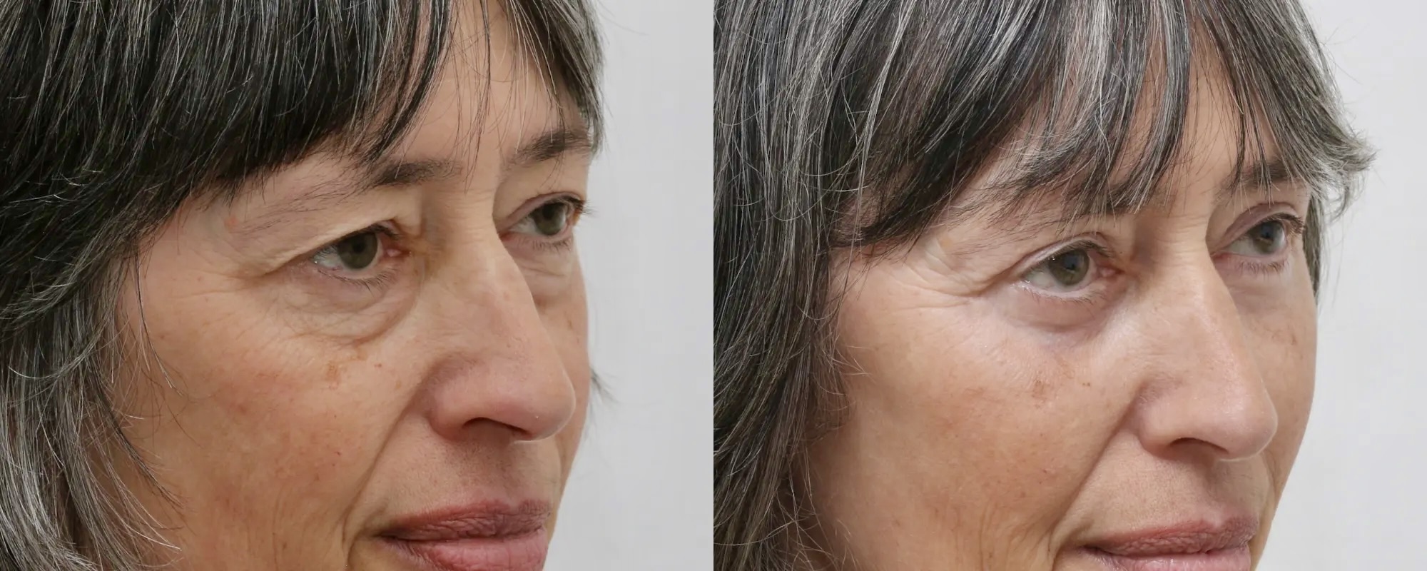 Upper and lower eyelid surgery