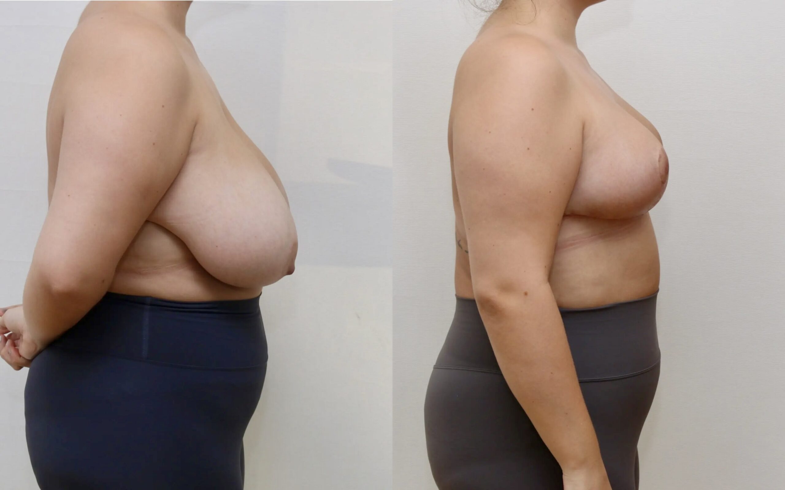 Breast reduction 4 weeks and 6 months post op