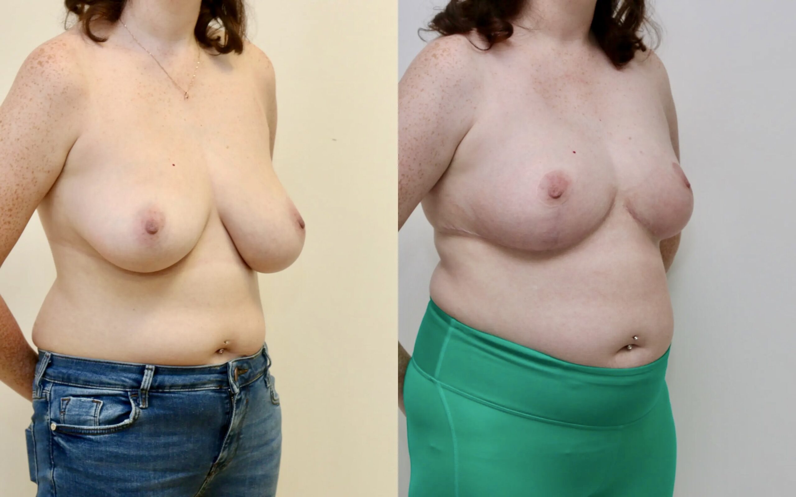 Breast uplift/ reduction for breast asymmetry