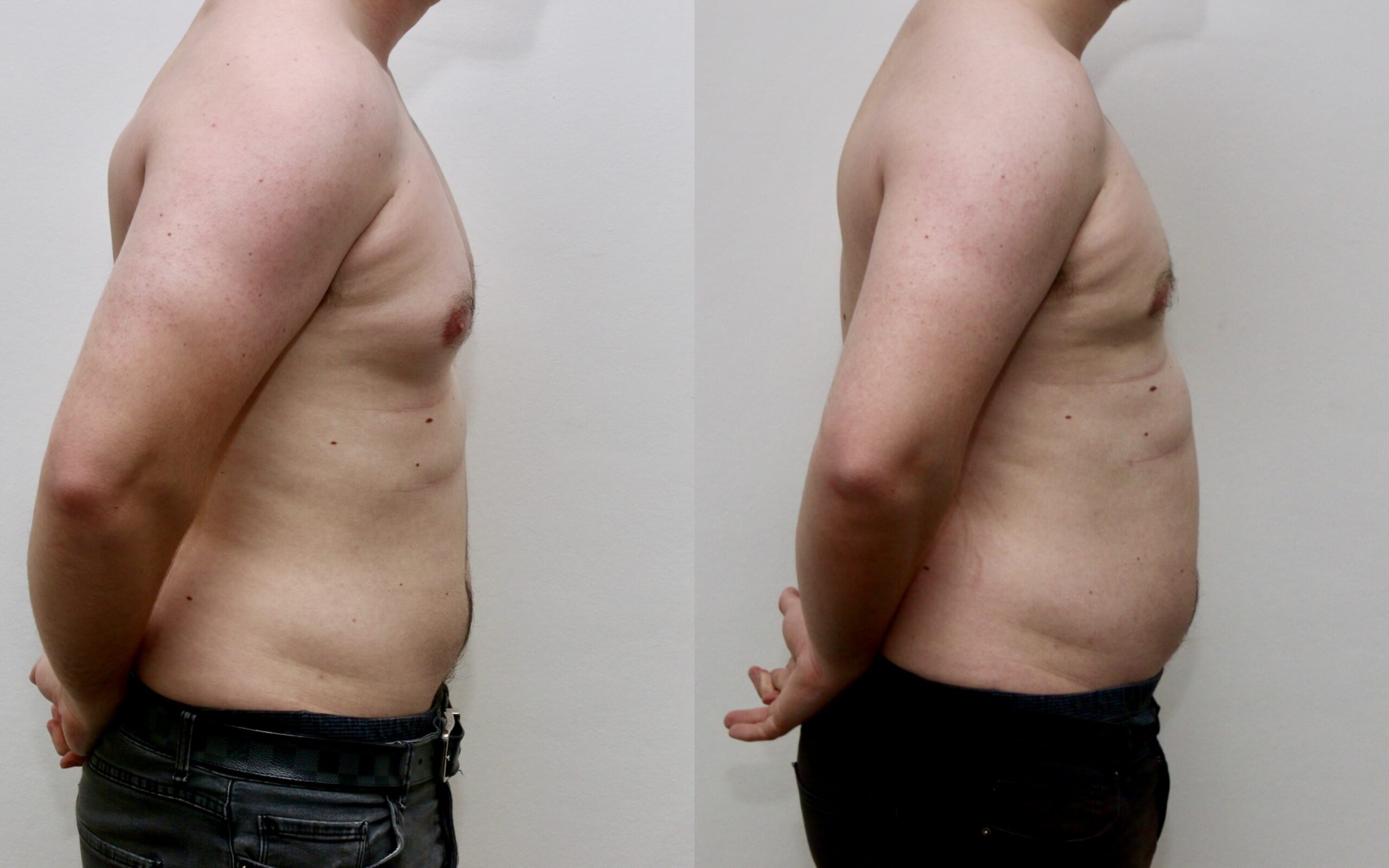 Standard liposuction only gynecomastia correction