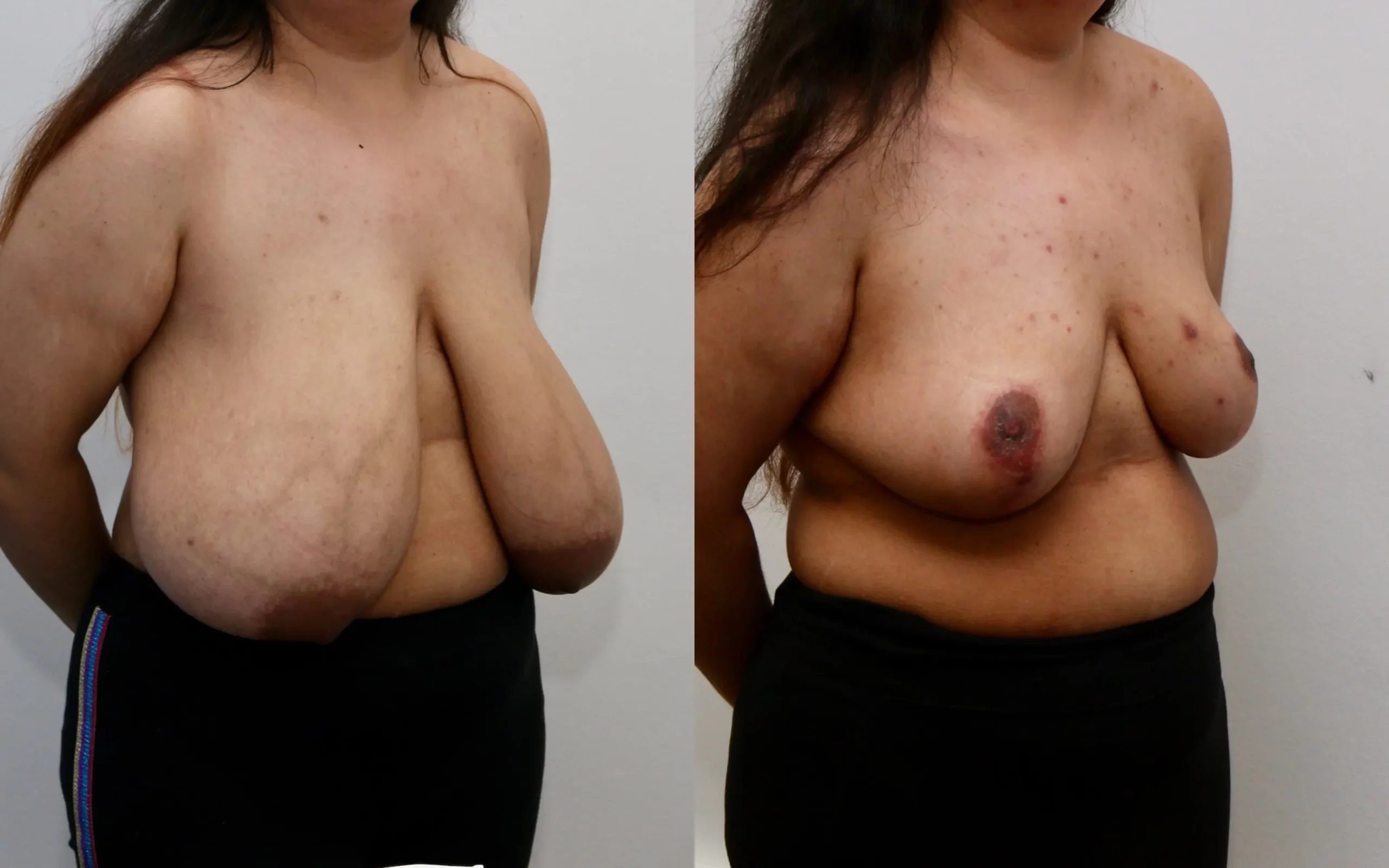 Large breast reduction