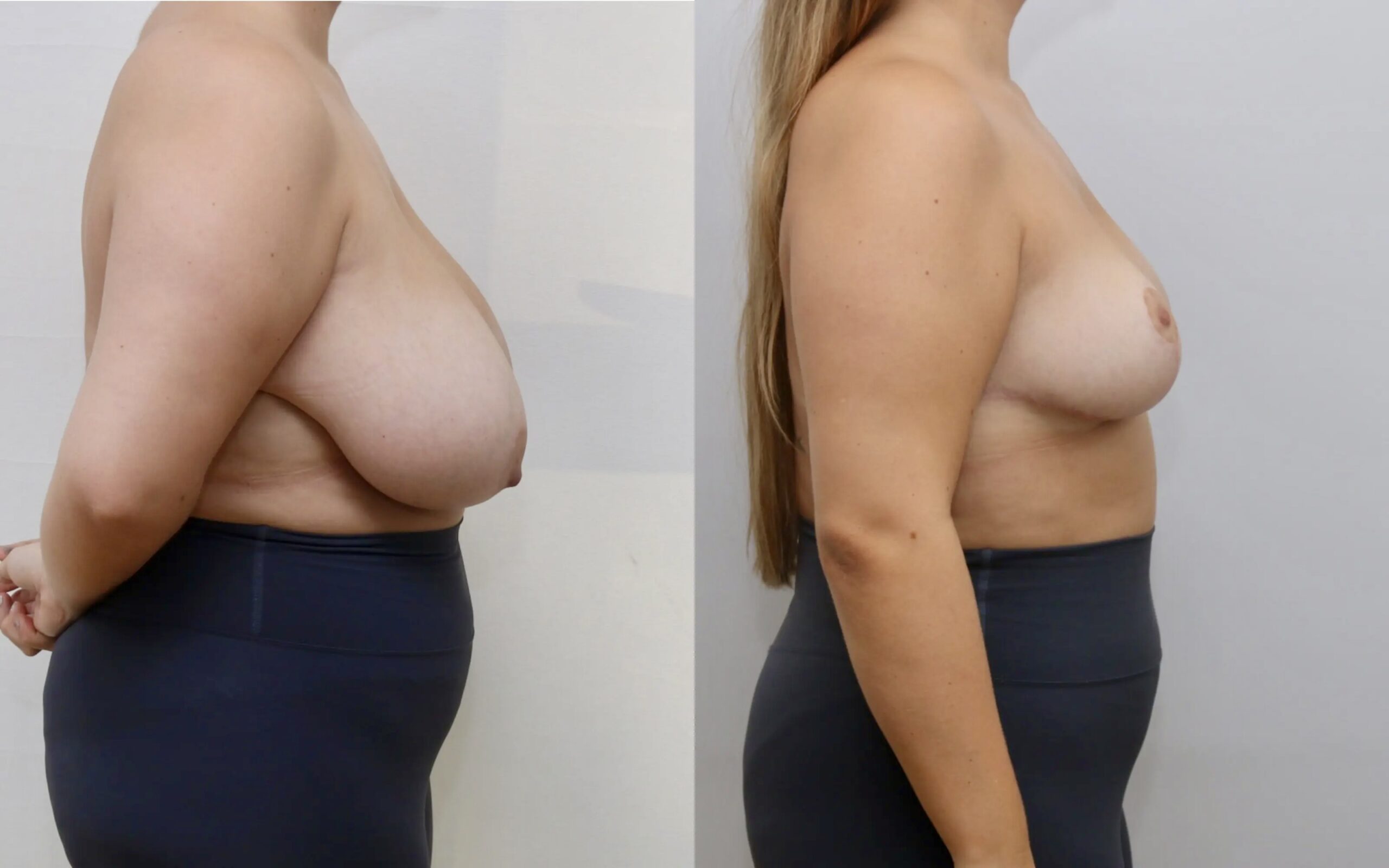 breast reduction before and after 6 months