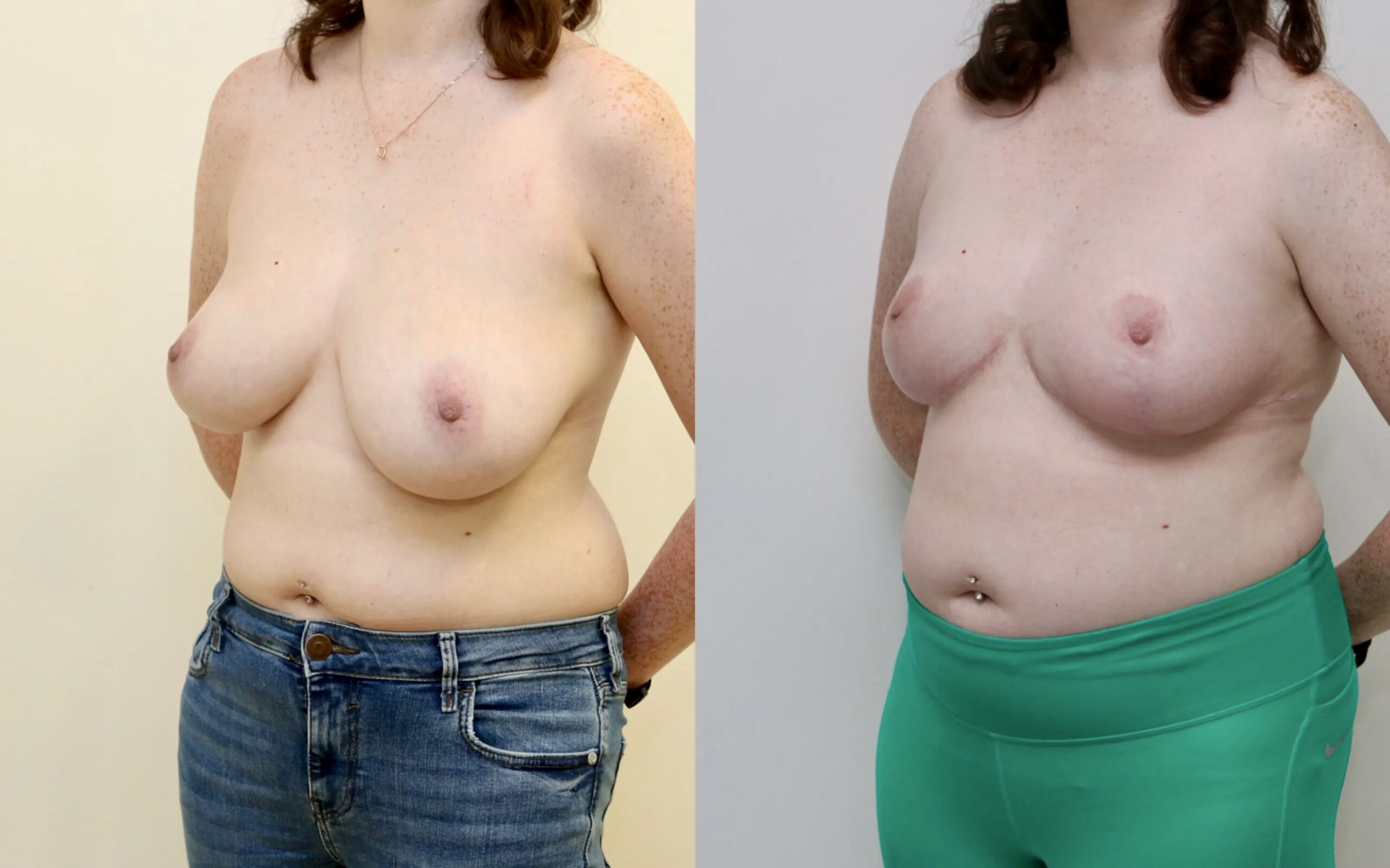 breast reduction for asymmetry