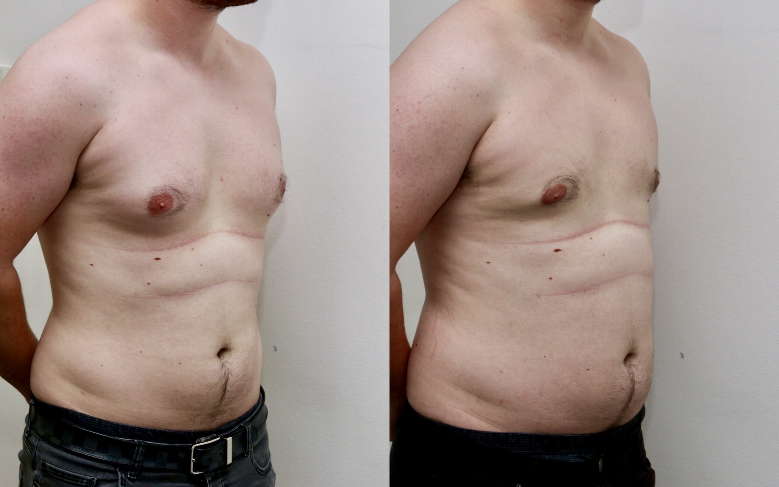 Standard liposuction only gynecomastia correction