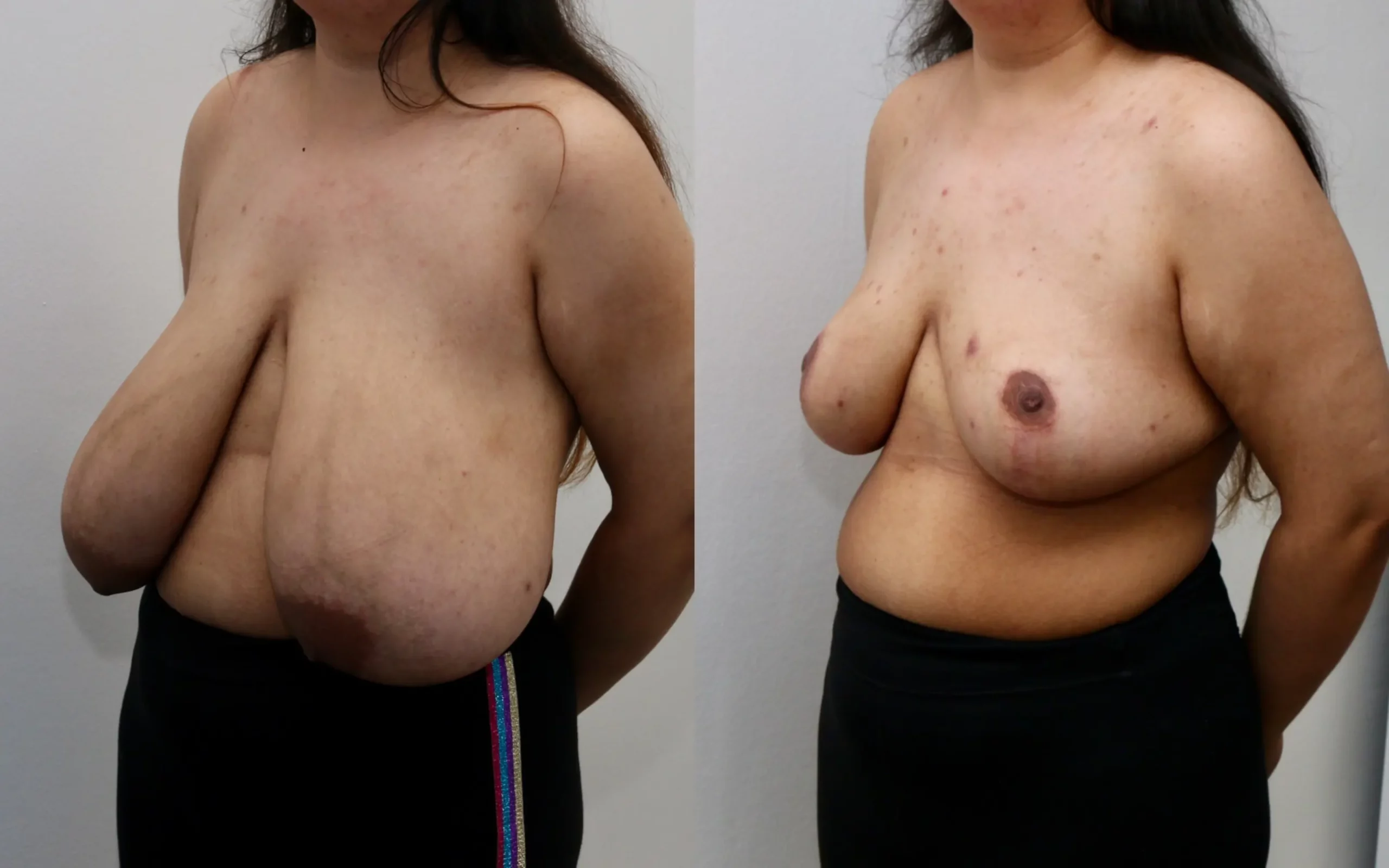 massive breast reduction