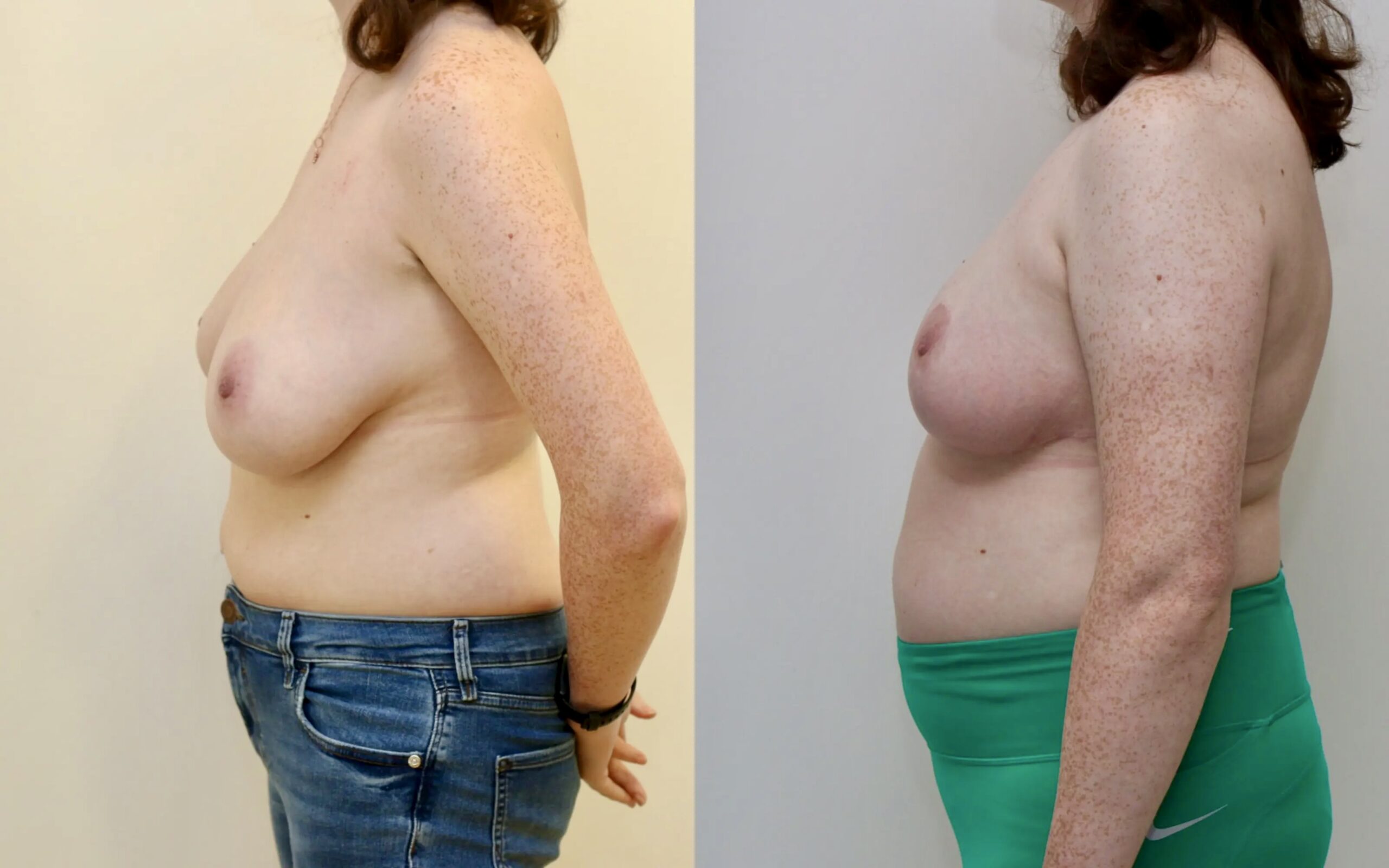 Breast uplift/ reduction for breast asymmetry