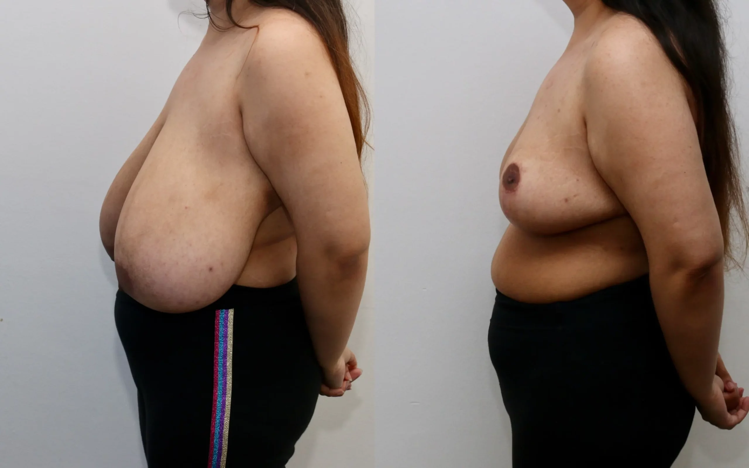 Large breast reduction