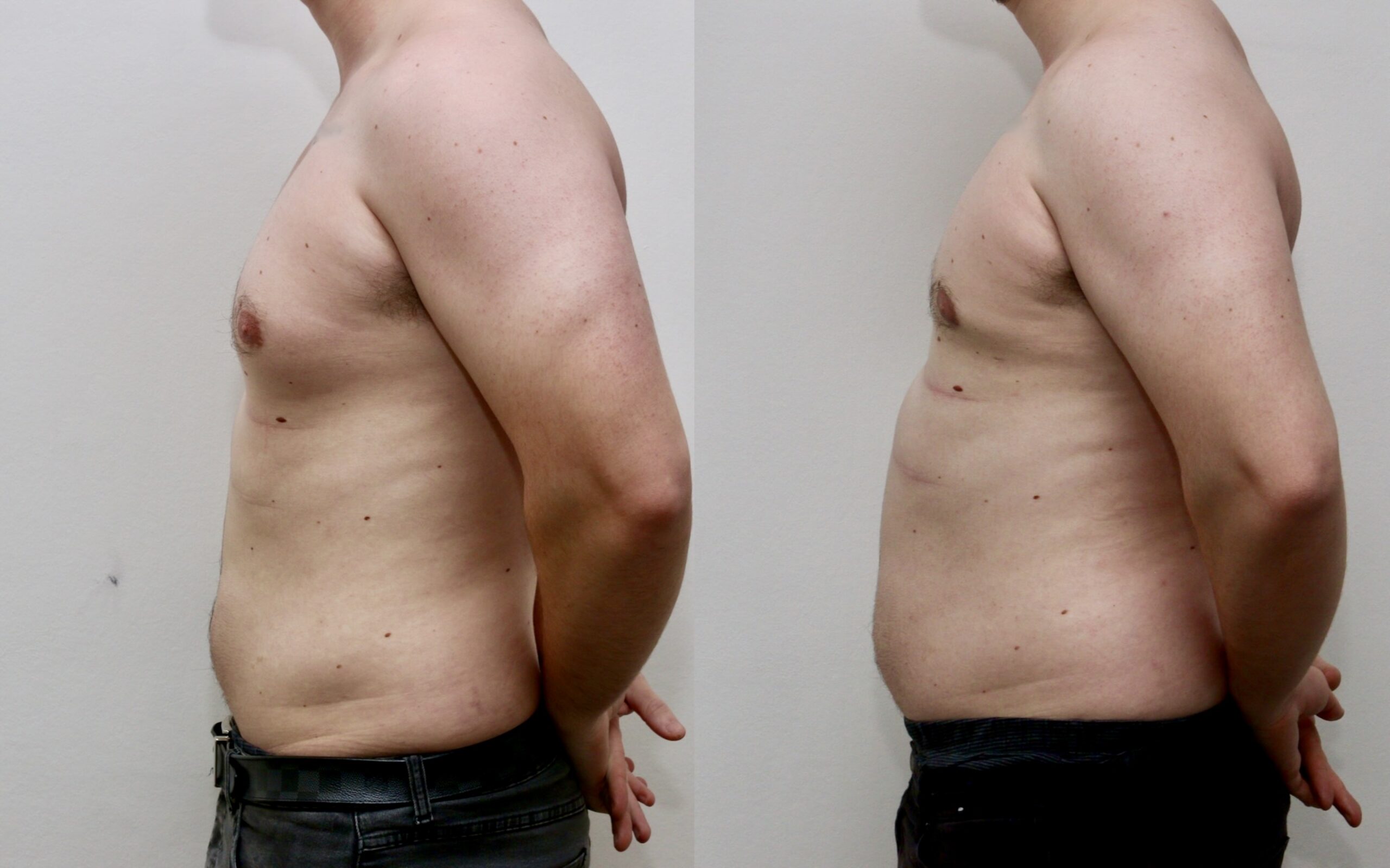 Standard liposuction only gynecomastia correction