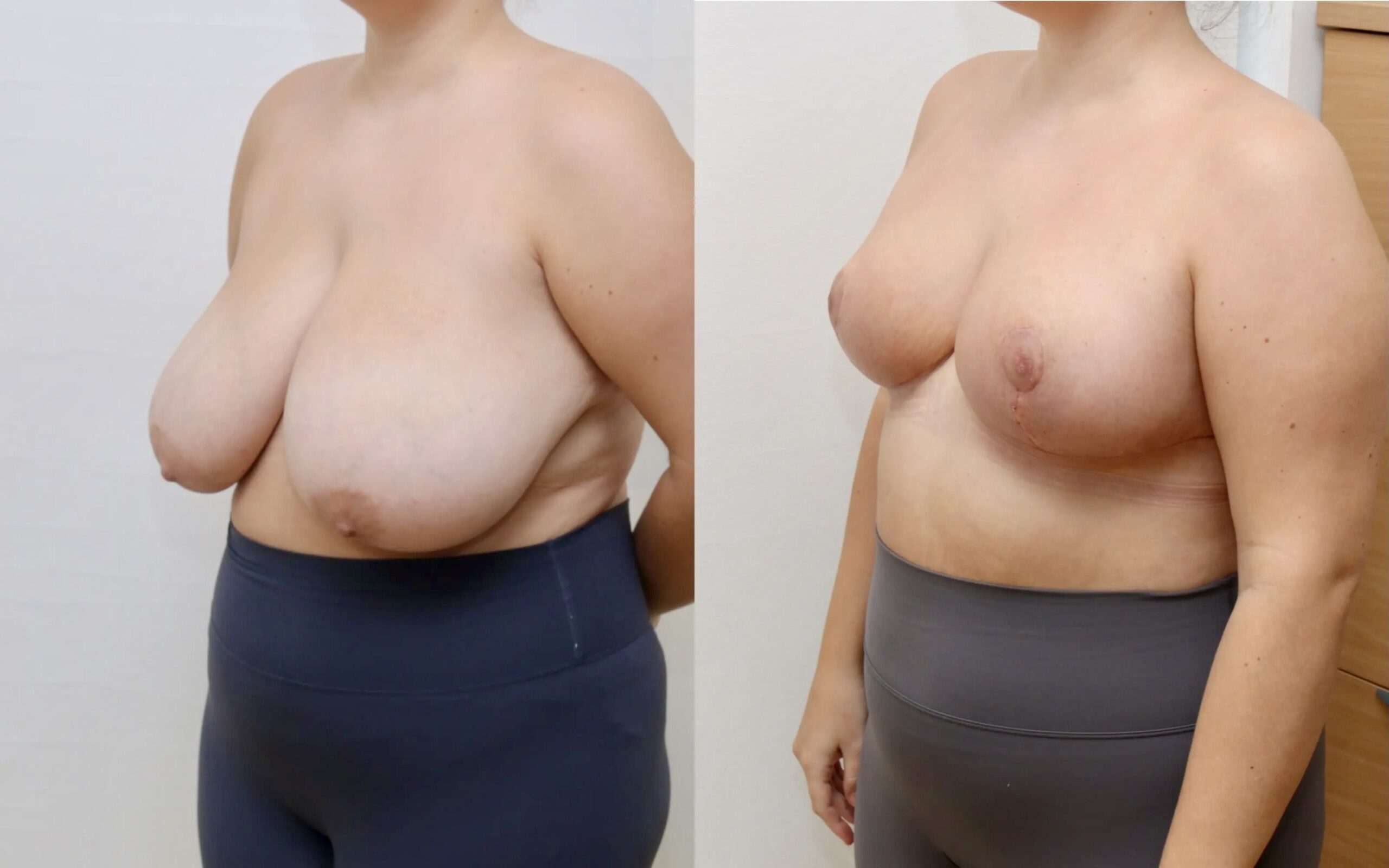 breast reduction before and after 4 weeks