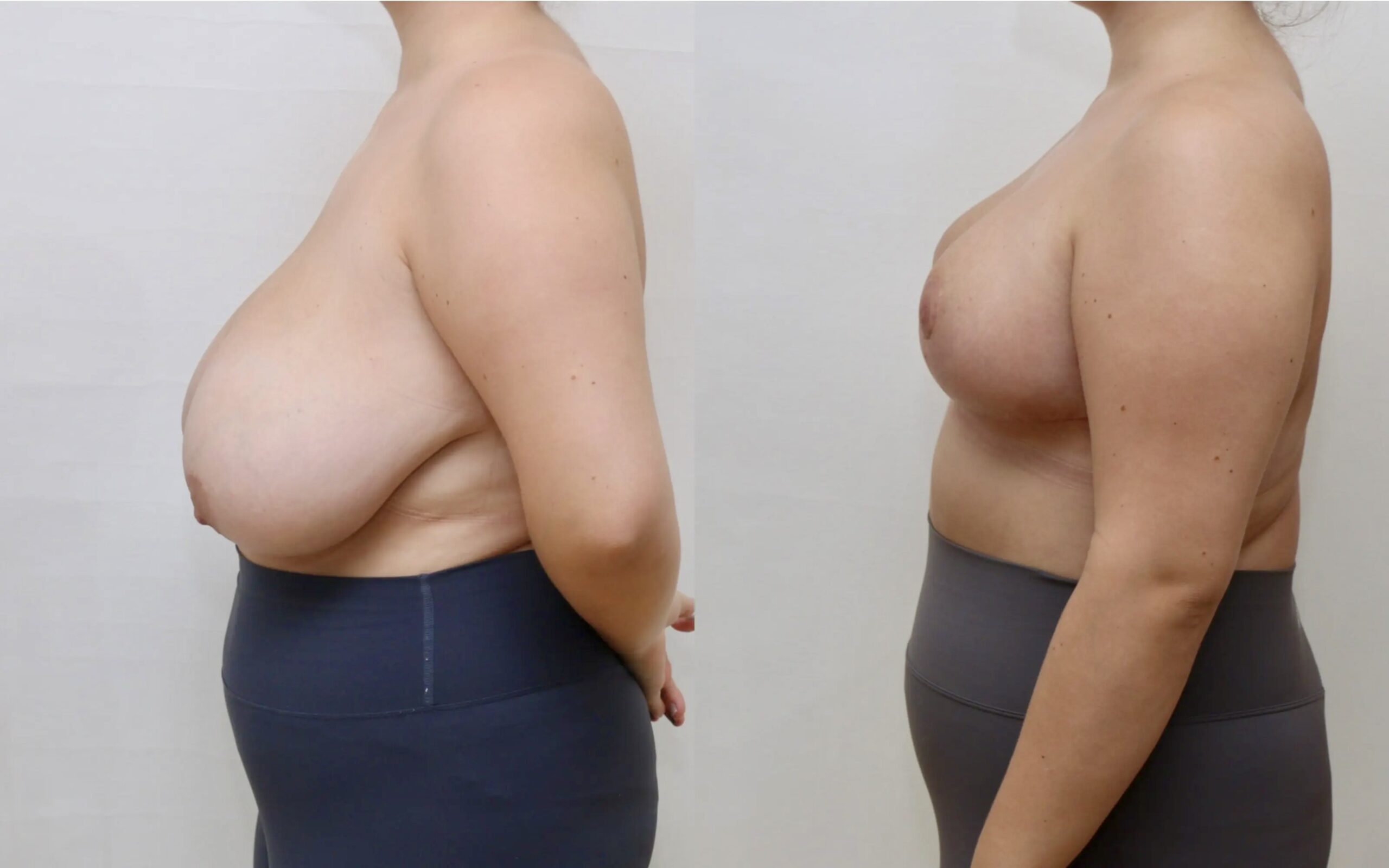 Breast reduction 4 weeks and 6 months post op