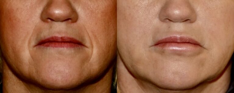 Dermal fillers for smile lines, before and after