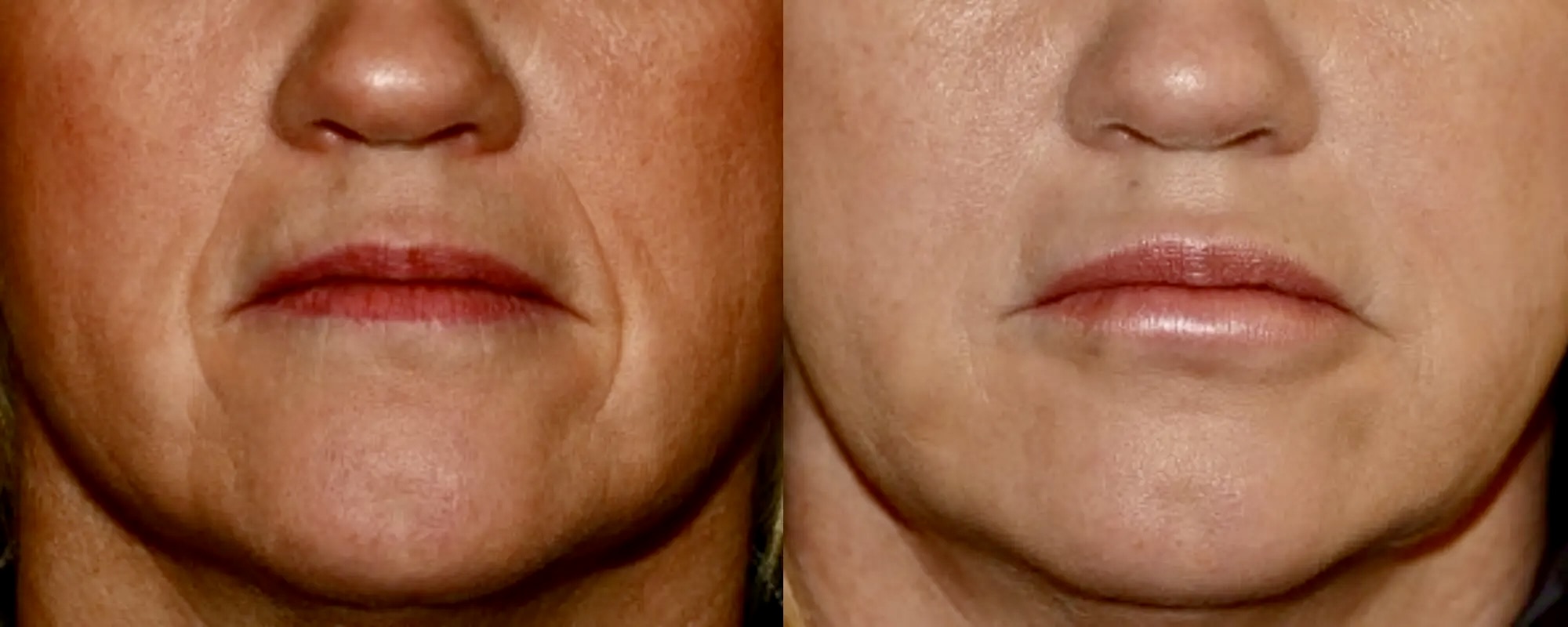 dermal fillers for smile lines