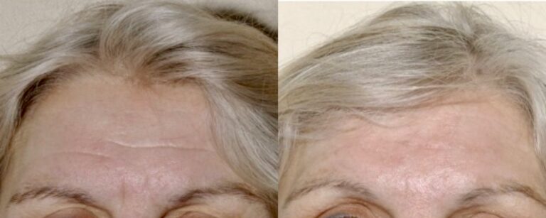 Dermal fillers: forehead lines fillers, before and after