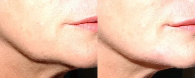 Dermal fillers: juvederm to improve jawline, before and after