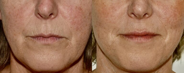 Dermal fillers: filler upper lip lines, before and after