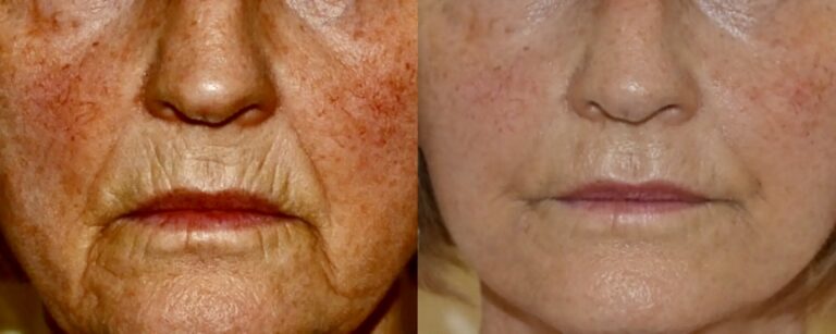 Dermal fillers: fillers for mouth lines, before and after
