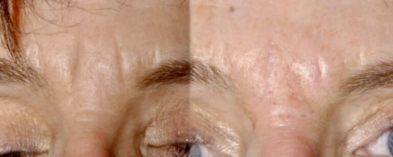 Dermal fillers to frown lines, before and after
