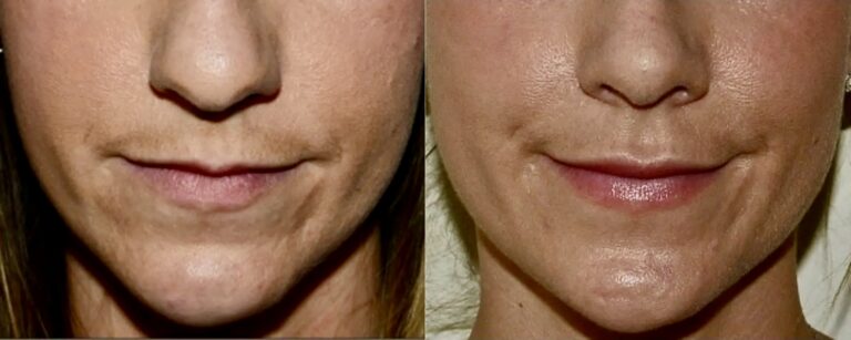 Dermal fillers: upper lip fillers, before and after, case 4
