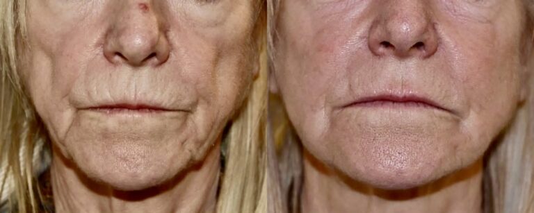 Dermal fillers: non surgical facelift with fillers, before and after