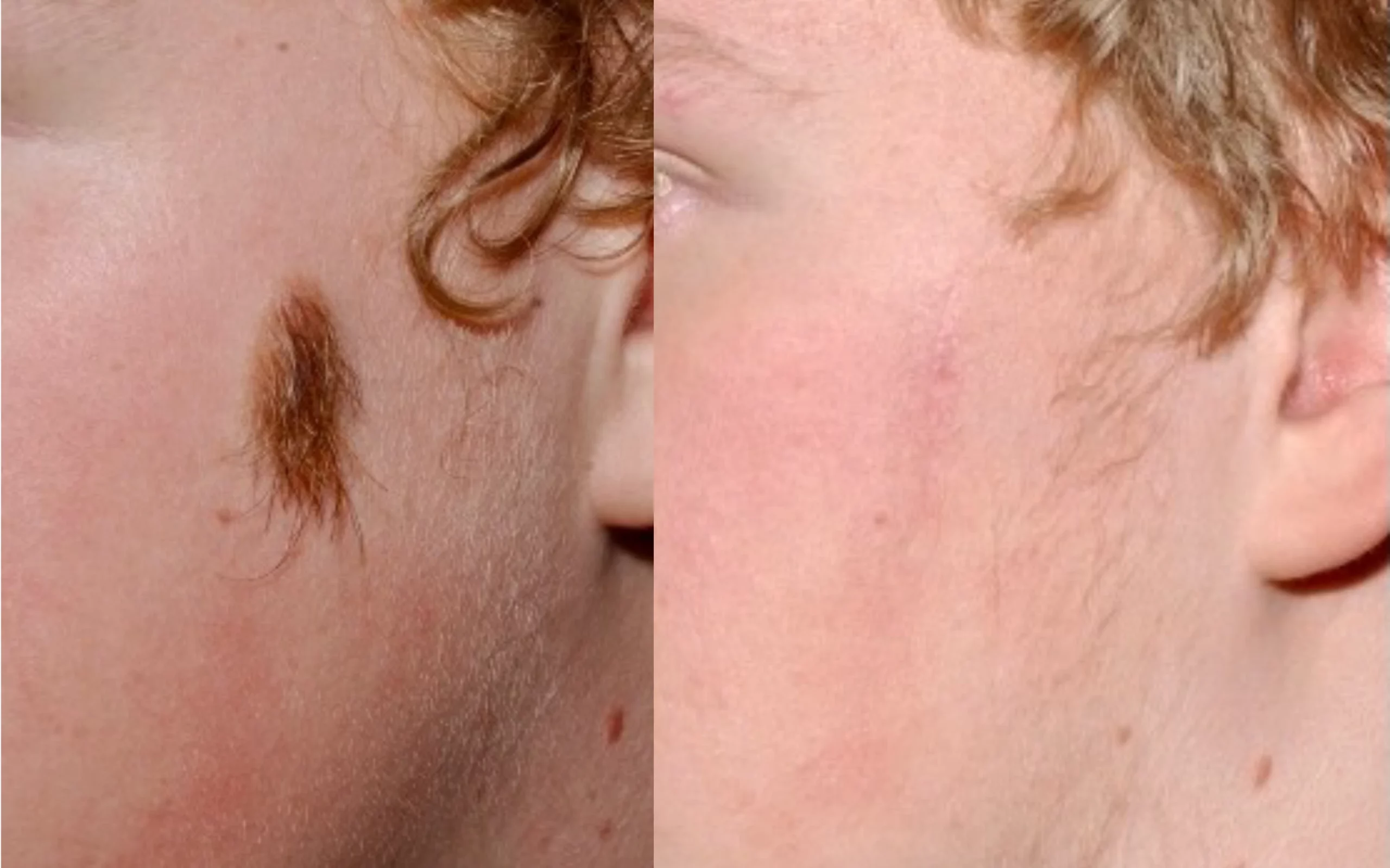 Removal of birthmark cheek