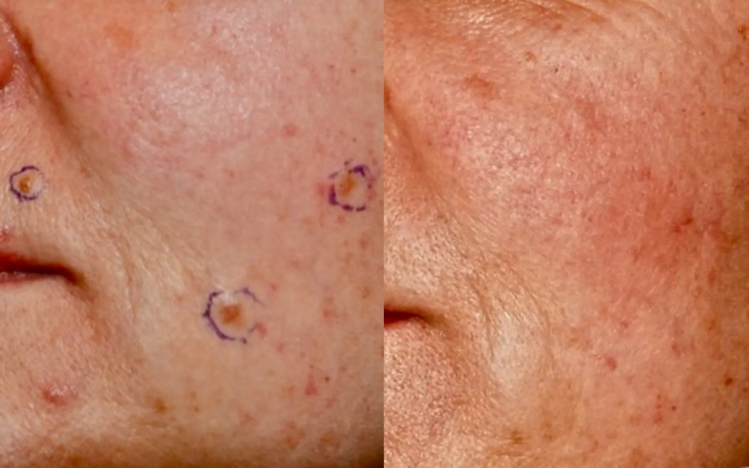Before and after mole removal
