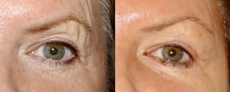 Dermal filler brow lift, before and after