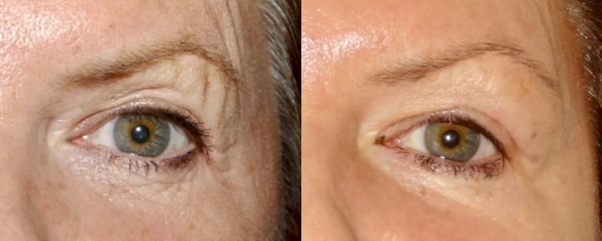 Dermal filler brow lift