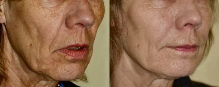 Dermal fillers: facelift with fillers, before and after