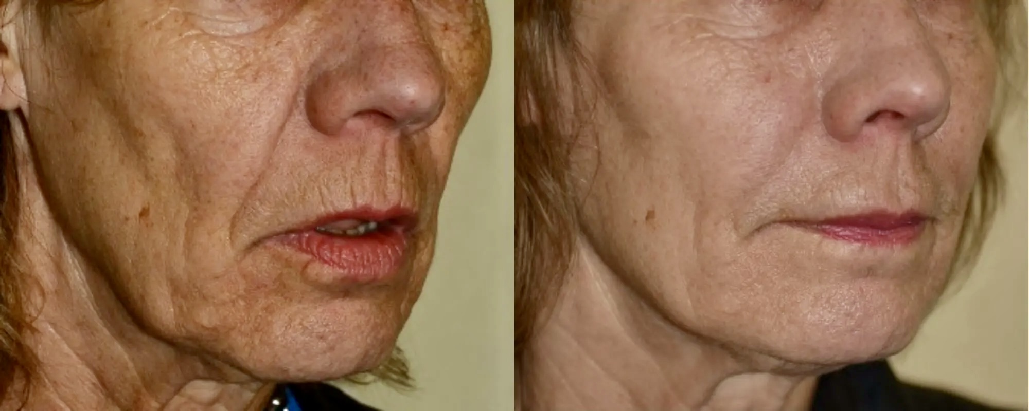 facelift with fillers