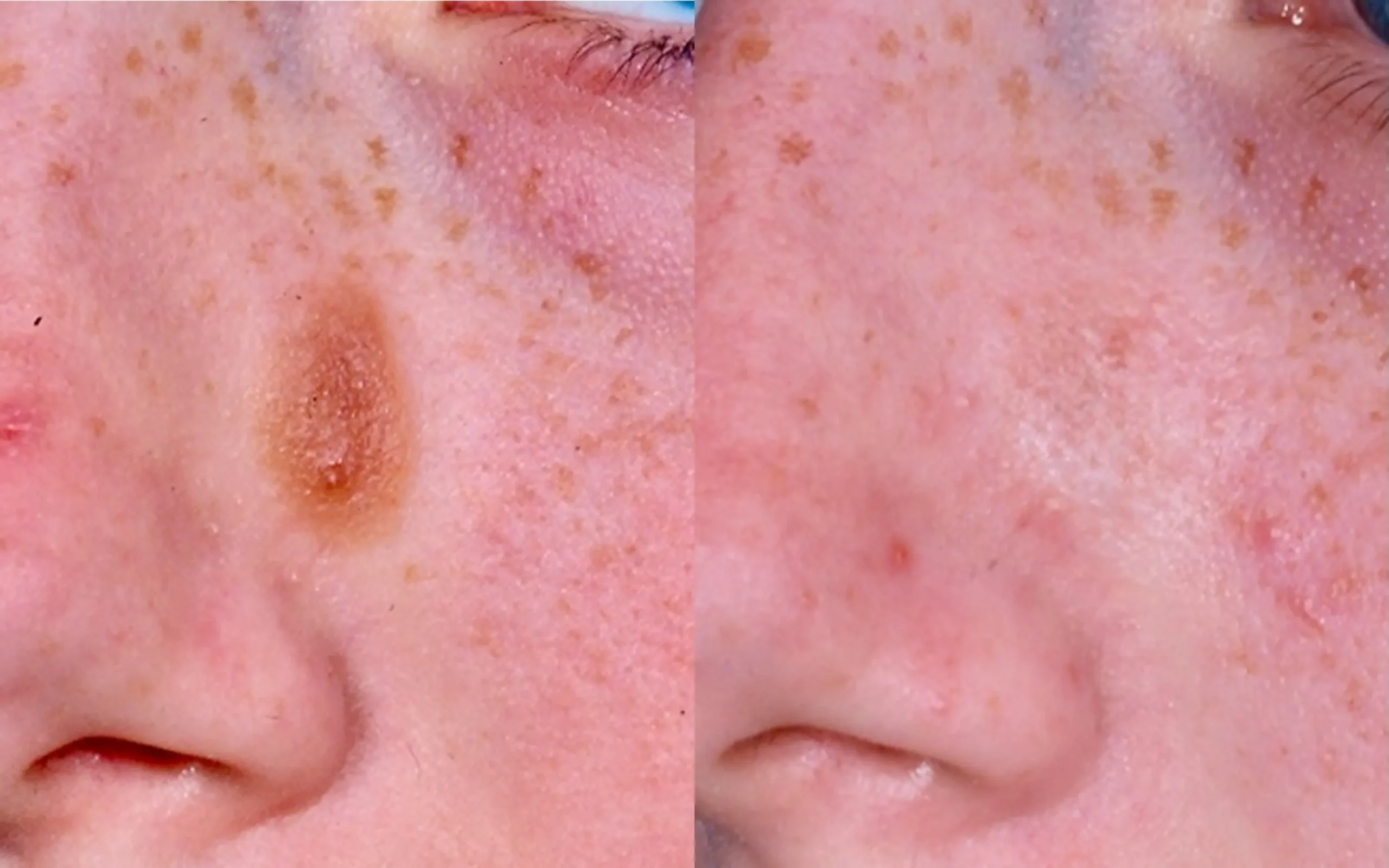 seb keratosis removal laser