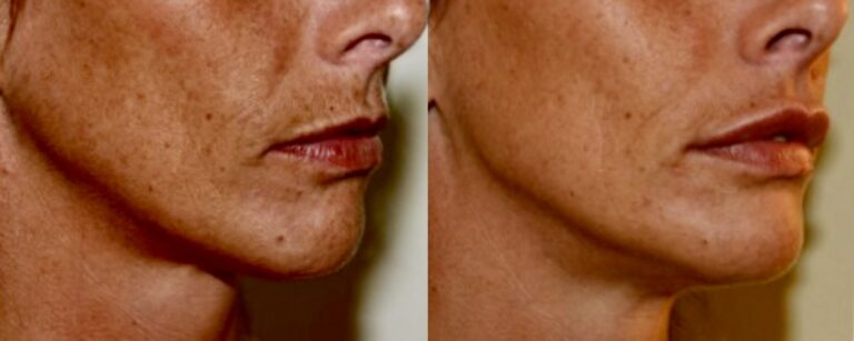 Dermal fillers: upper lip fillers, before and after, case 3