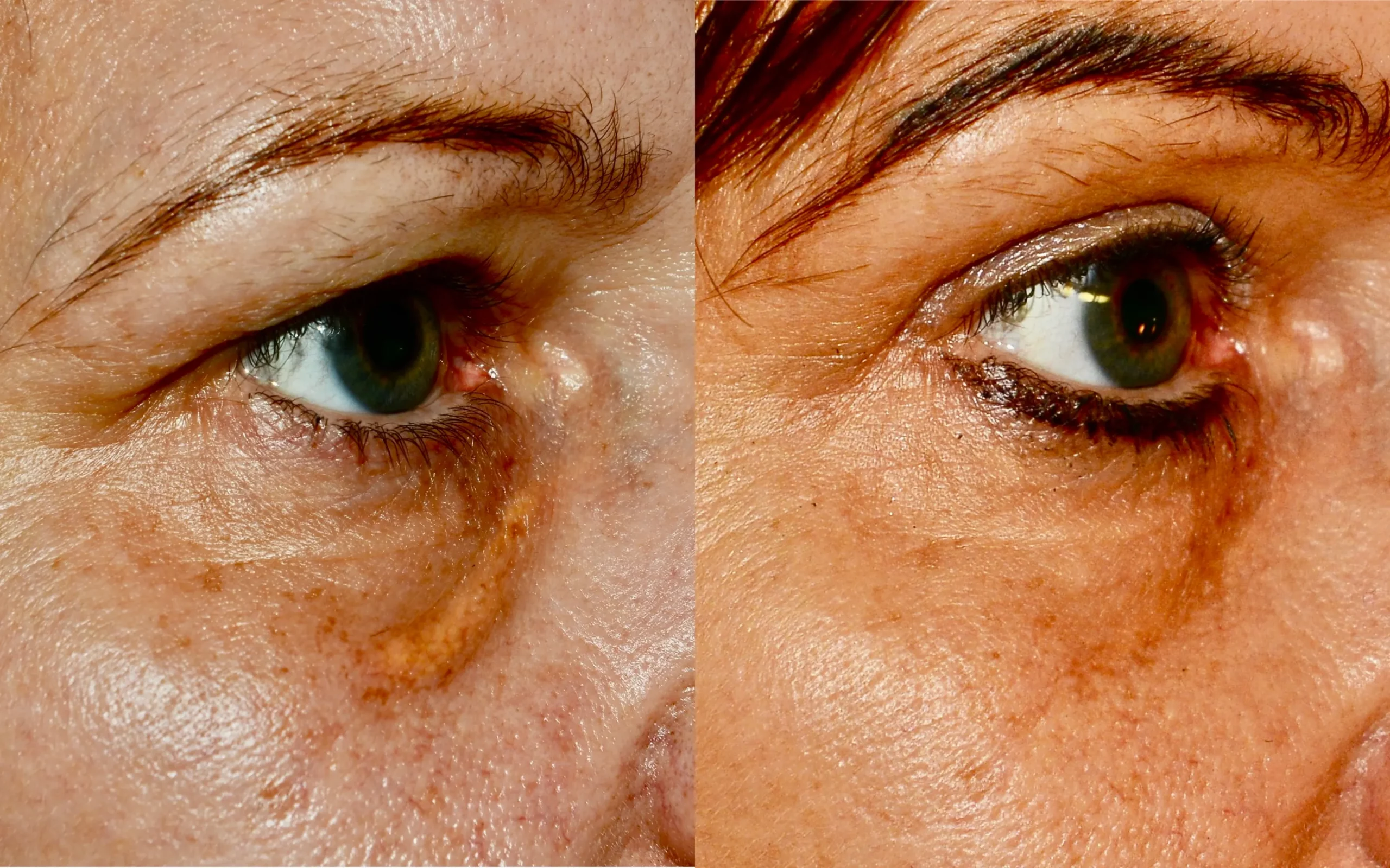 Removal of lower eyelid xanthelasma