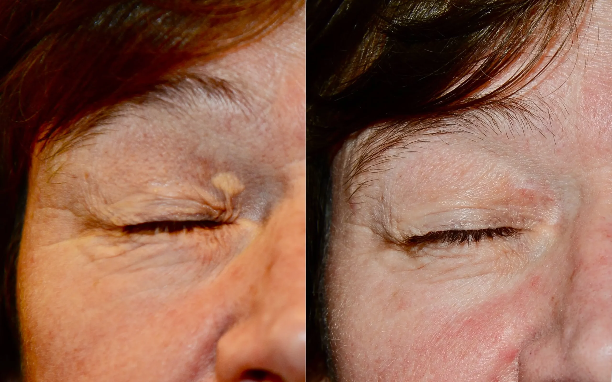 xanthelasma removal edinburgh