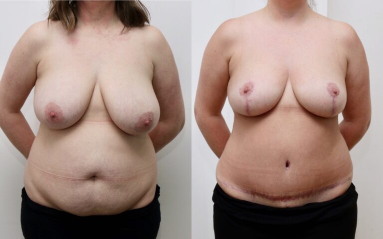 Mummy makeover before and after, case 12, photo 1 of 5