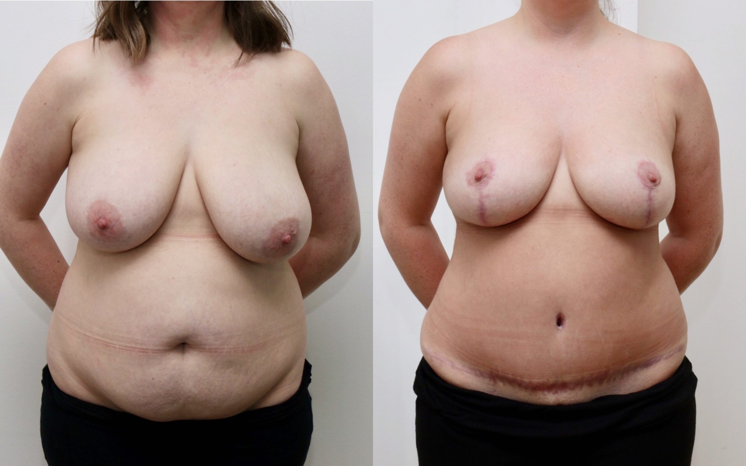 mummy makeover tummy tuck scotland