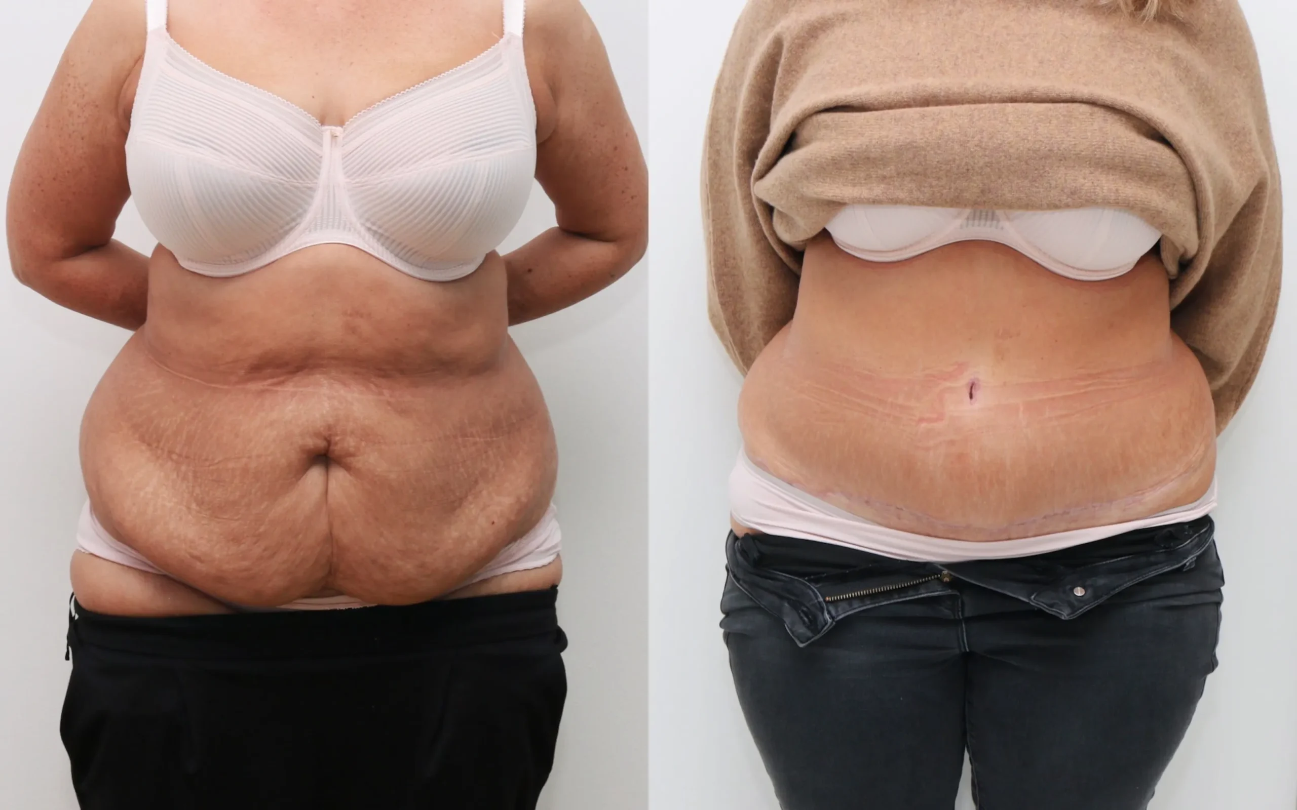 Tummy Tuck Before and After Photos