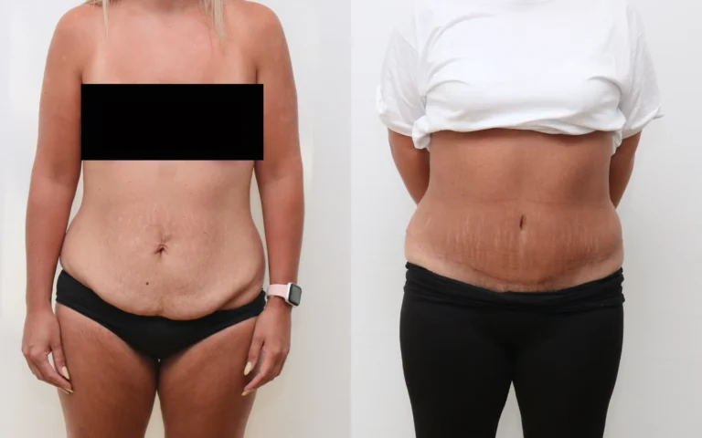 Full tummy tuck - 2024x before and after, photo 1 of 5