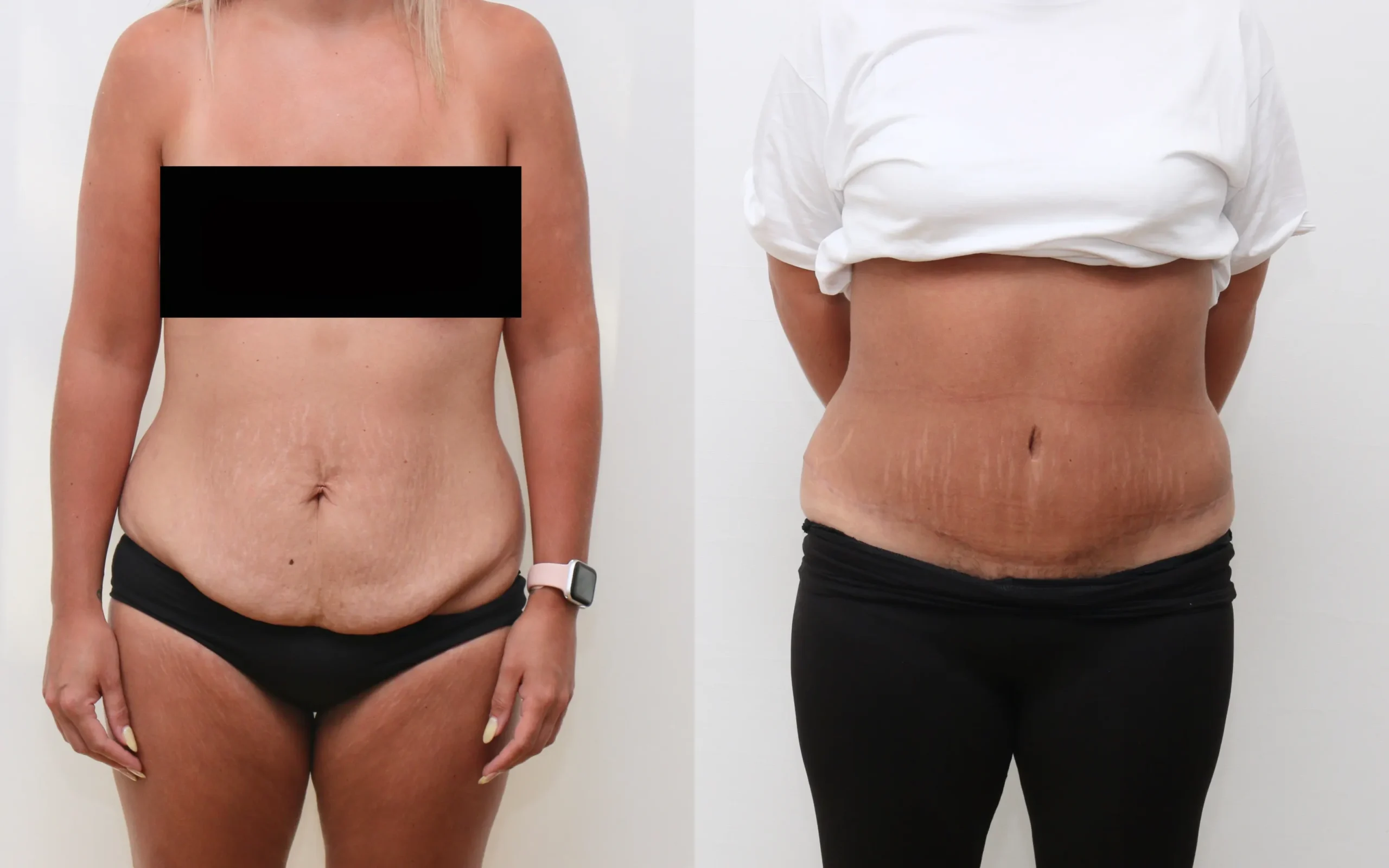 abdominoplasty edinburgh