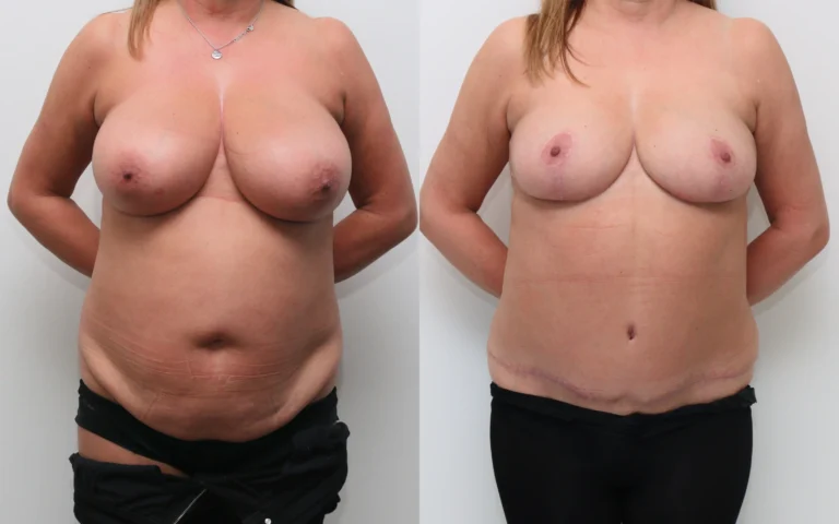 Mummy makeover 24x before and after, photo 1 of 5