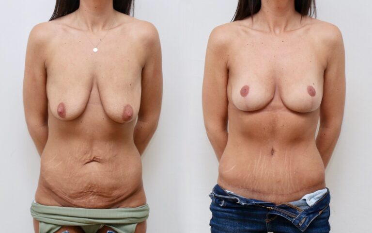 Weightloss/ mummy makeover before and after, photo 1 of 6