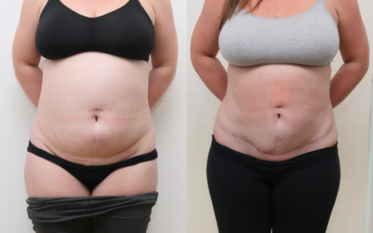 Mini tummy tuck plus liposuction before and after, photo 1 of 5