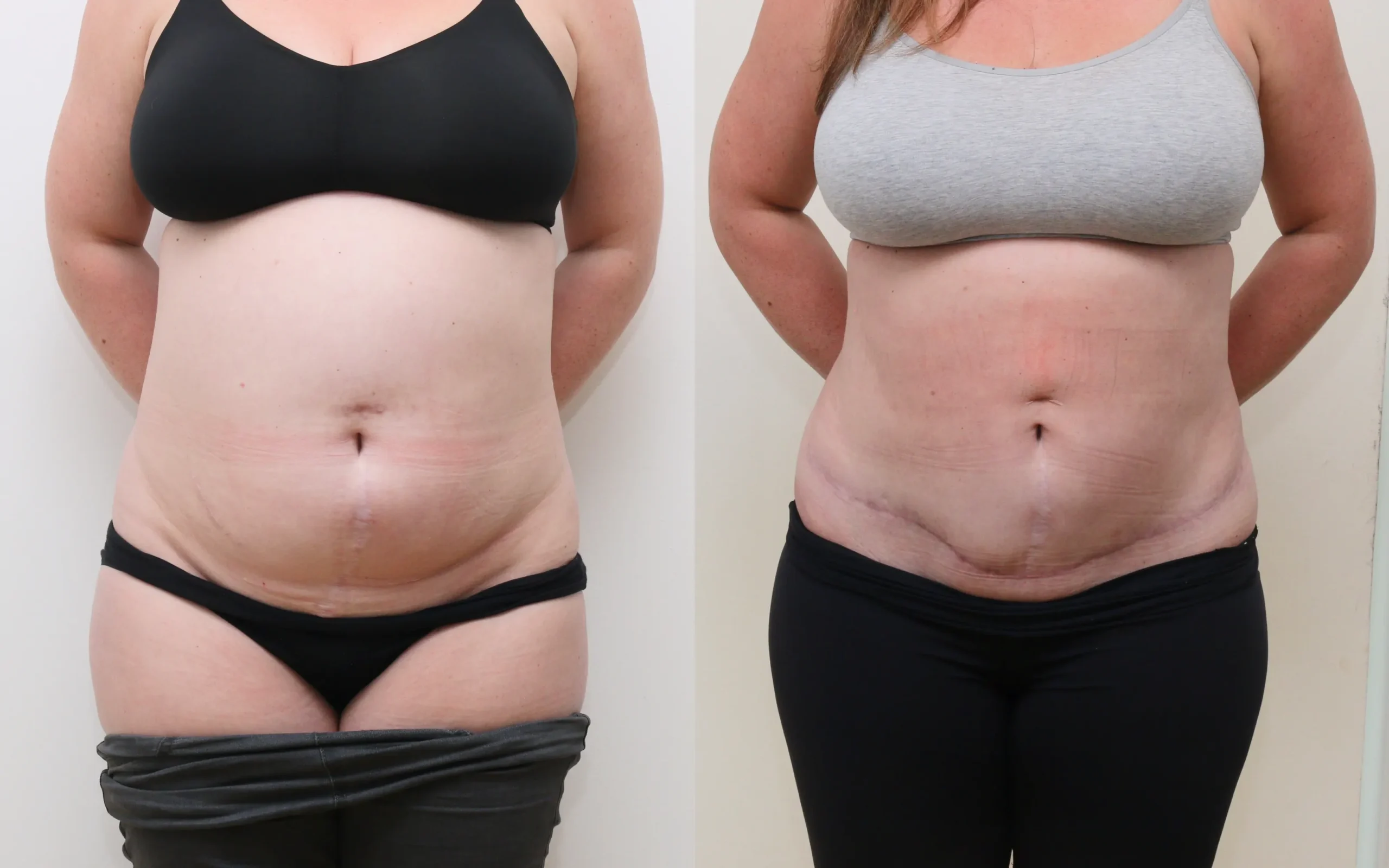 tummy tuck scotland