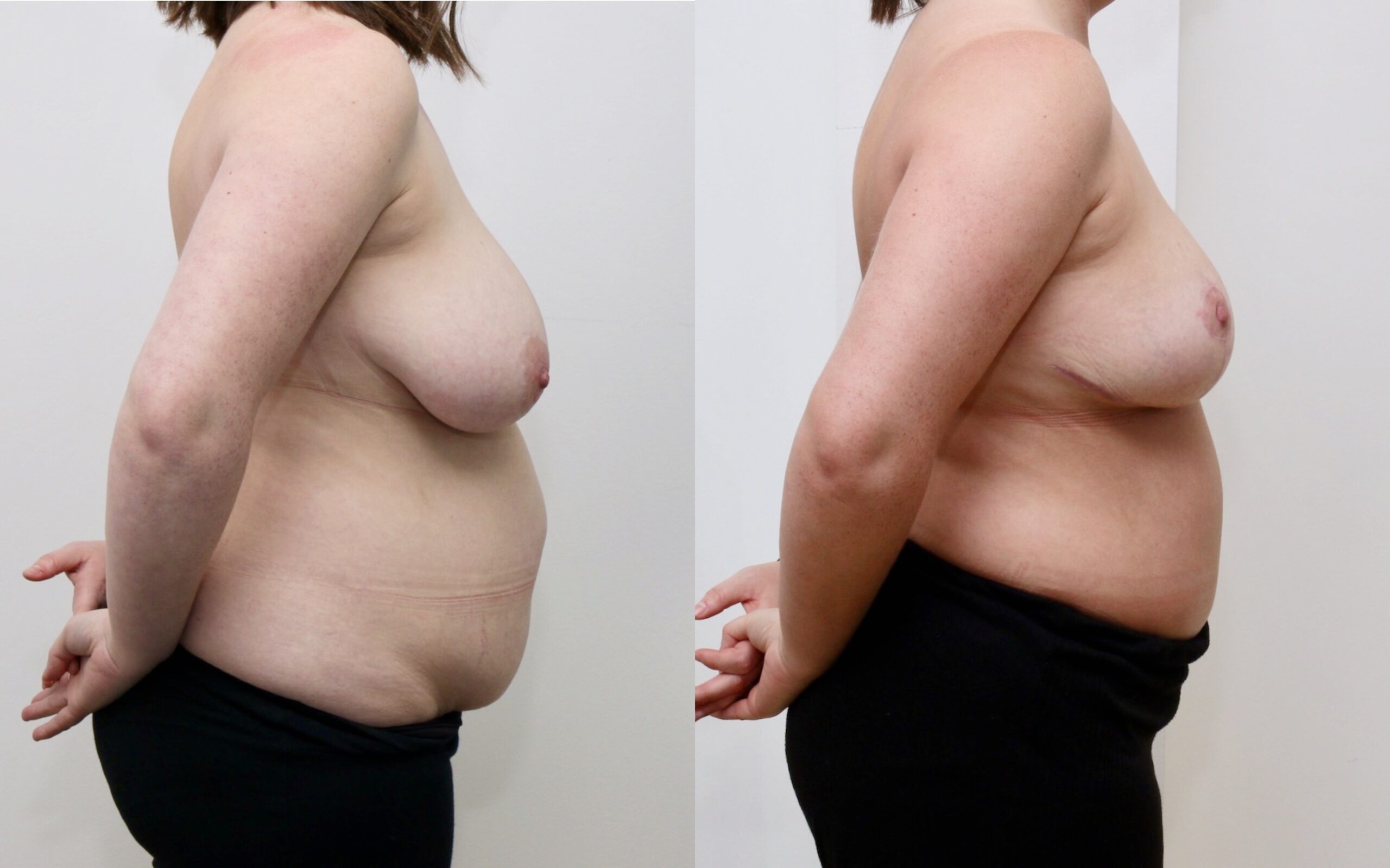 Tummy tuck and small breast reduction/ uplift