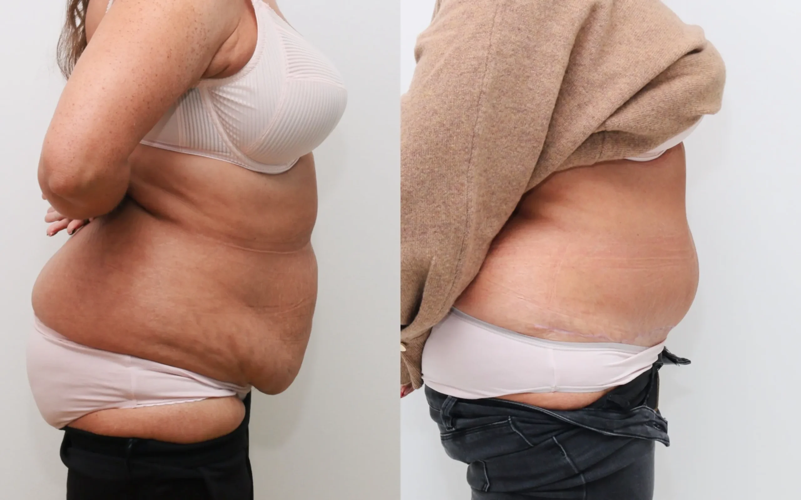 Full tummy tuck plus lipo