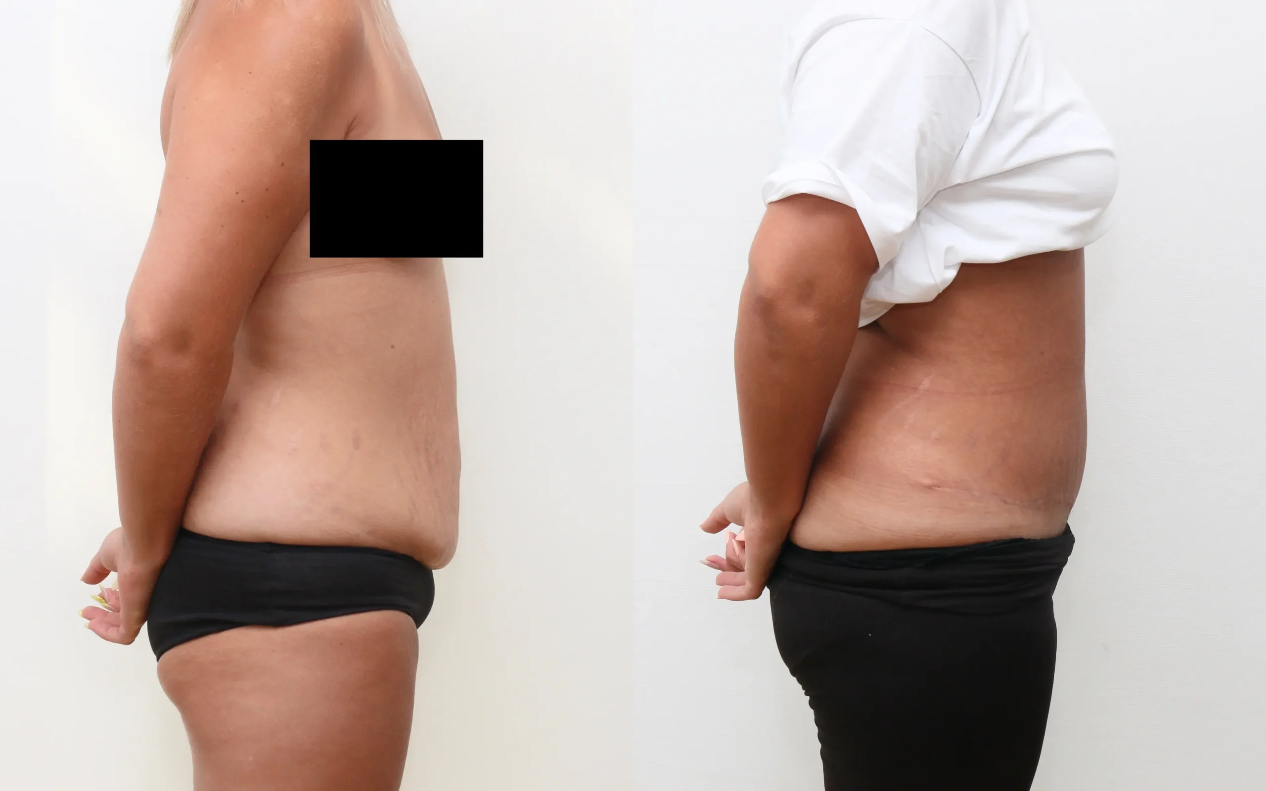 Tummy tuck before and after