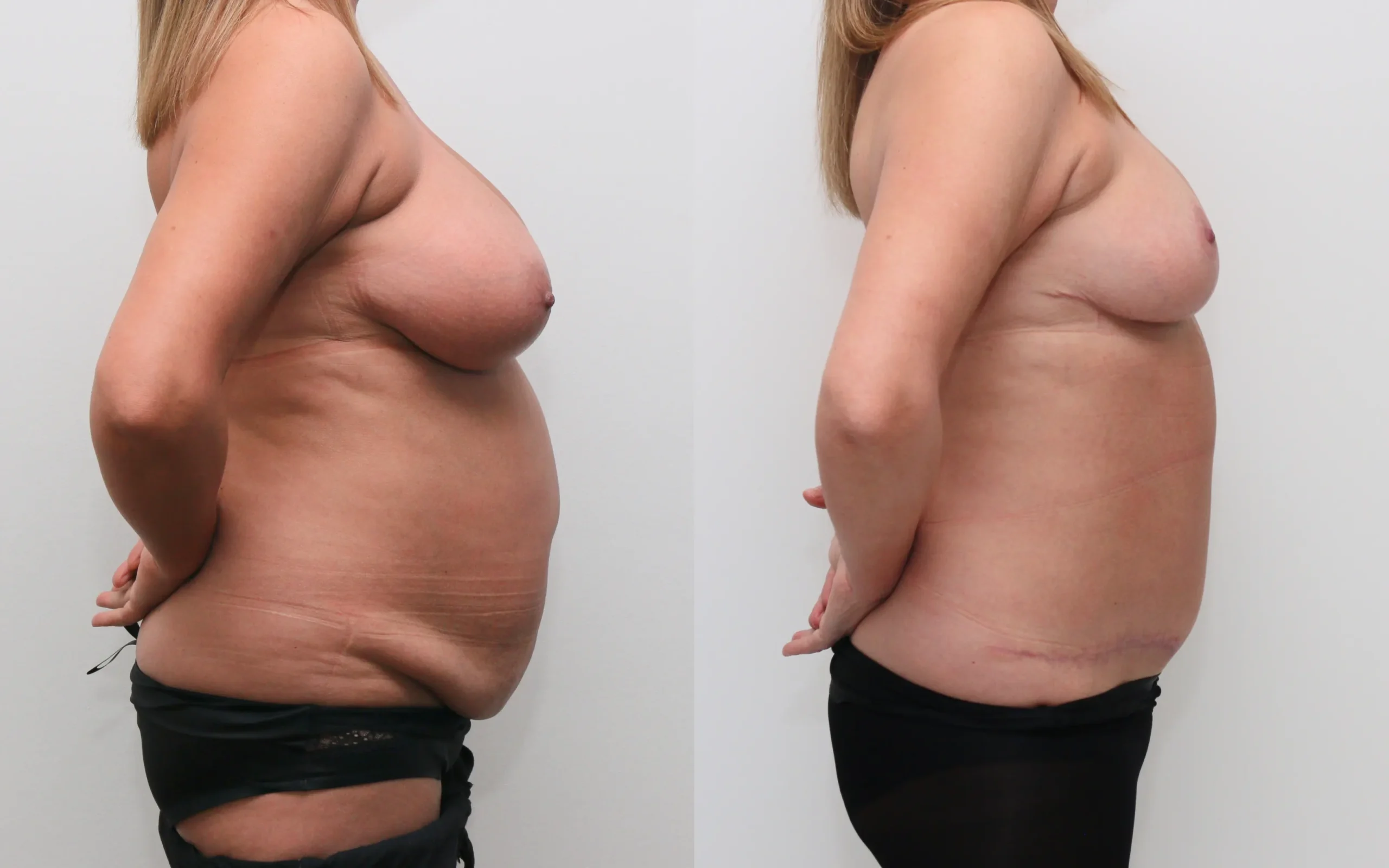 Breast reduction and full tummy tuck