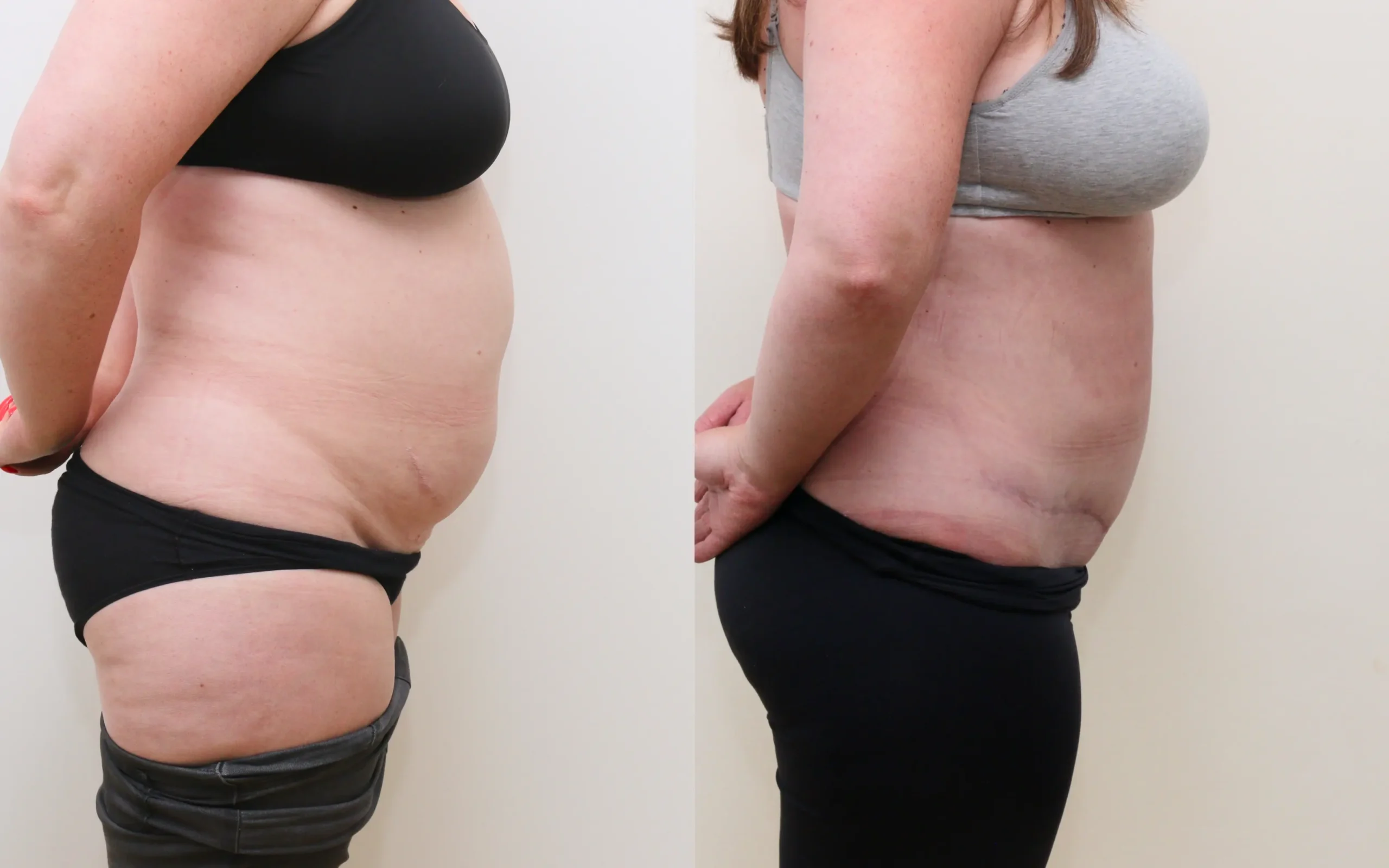 Mini tummy tuck plus lipo