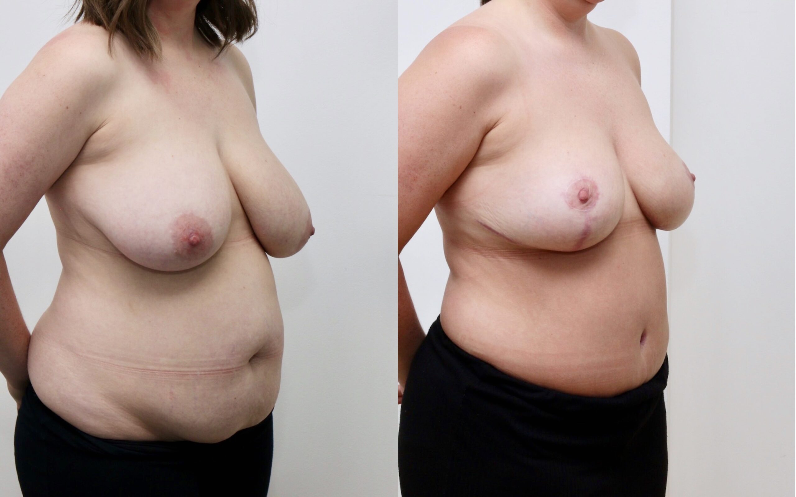breast uplift and tummy tuck before and after