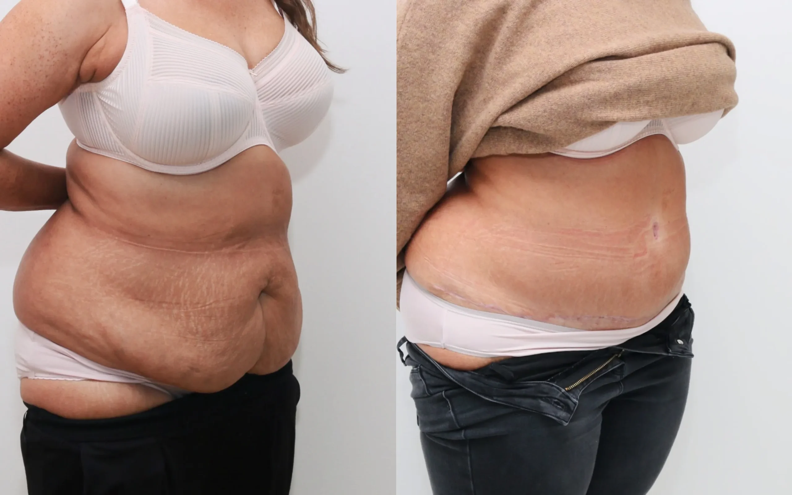 Full tummy tuck plus lipo