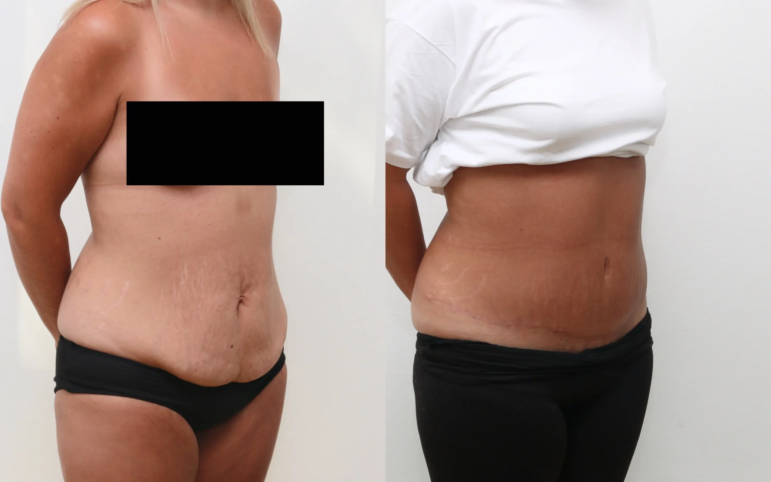 Tummy tuck before and after